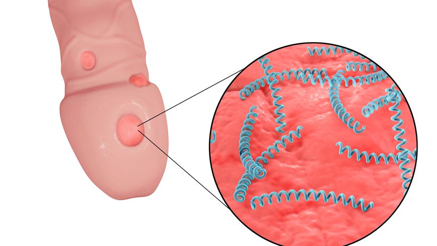 Syphilis Traitement Naturel Guérison Causes symptômes