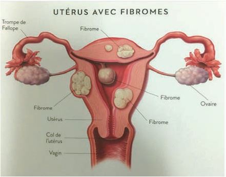 Traitement Des Fibromes Des Myomes Comment Enlever Un Fibrome ?