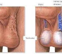 Varicocèle Causes Traitement Naturel Africain Varicocèle