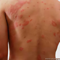 Crème contre Mycoses Herpes Vaginites et Les Maladies de la Peau. Soignez avec les plantes ces maladies infectieuses et indésirables.