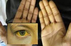 Traitement Naturel Hépatite C, le virus peut être à l'origine d'une hépatite aiguë et chronique allant d'une forme bénigne à sévère