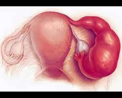 Traitement naturel efficace annexite