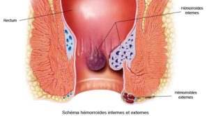 Hémorroïdes symptômes causes étapes
