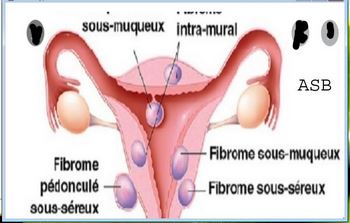 Mon Fibrome a Disparu Naturellement : Traitement Fibrome