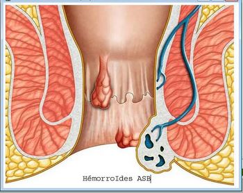 Maladie Hémorroïdaire : Comment Soigner Hémorroïdes Naturellement?
