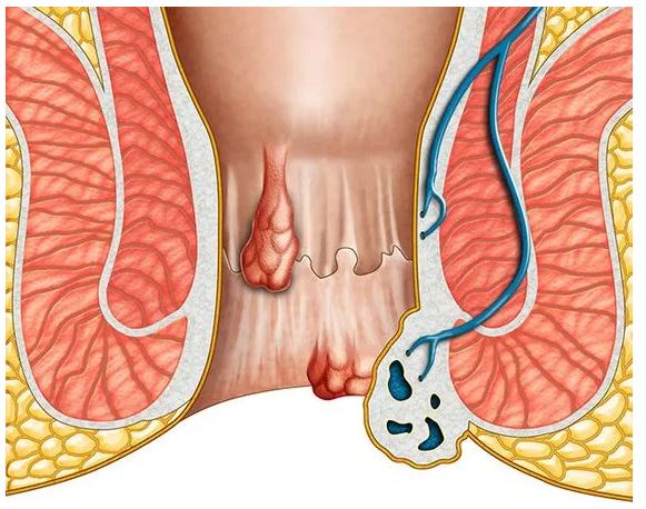 Hémorroïdes : Recettes Naturelles Pour Soigner les Hémorroïdes