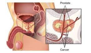Prostate Traitement Naturel