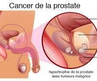 Traitement naturel cancer prostate
