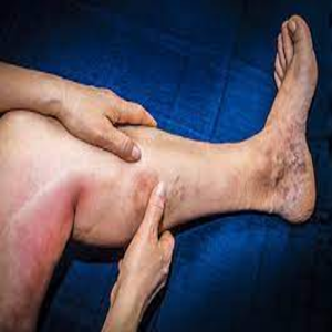 TEV et son traitement