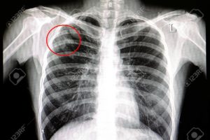 Explications et Symptômes de La Paragonimose
