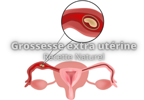 Connaître la Grossesse Extra-utérine et soigner