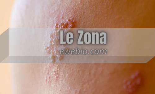 Comment Traiter le Zona Naturellement