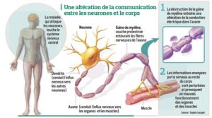 C'est Quoi La Sclérose en Plaques et Comment Traiter?