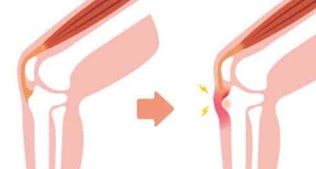 Osgood Schlatter : Comment Soigner Osgood Schlatter ?