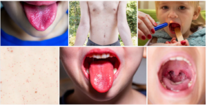 Remède Naturelle pour La Scarlatine