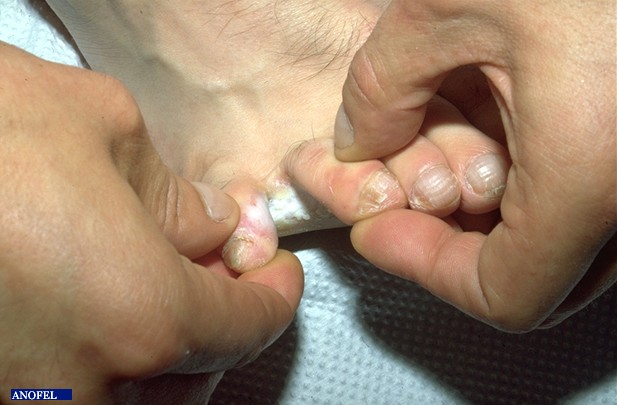 Remèdes naturel pieds d'athlète