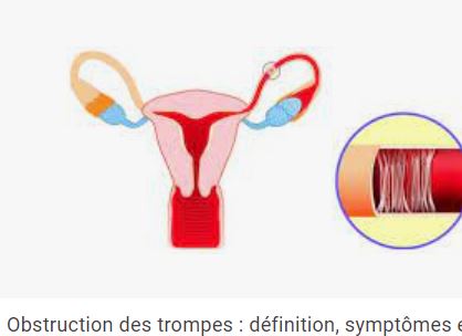 Obstruction Tubaire: Comment débloquer les trompes de Fallope?