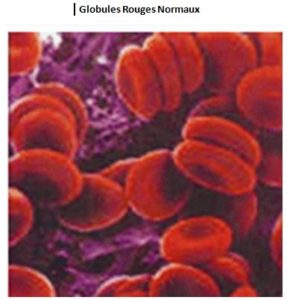 Différentes Formes de Drépanocytose : Traitement Naturel Drépanocytose