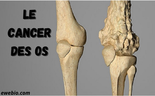 Idée de Plantes Pour Soigner le Cancer de l'Os