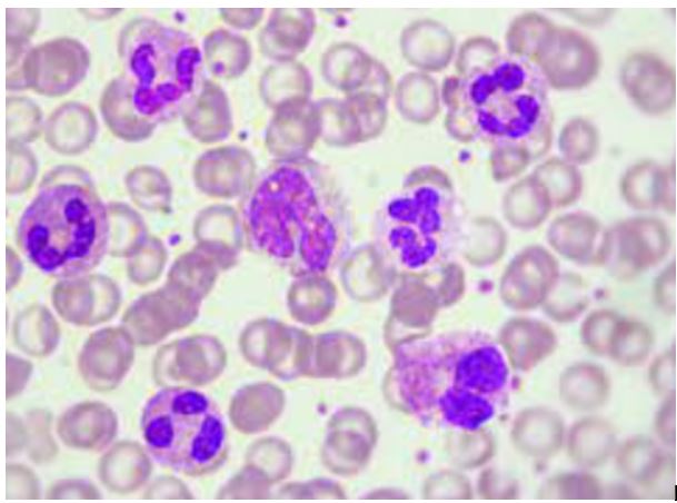 Soigner la Scarlatine Traitement Naturel