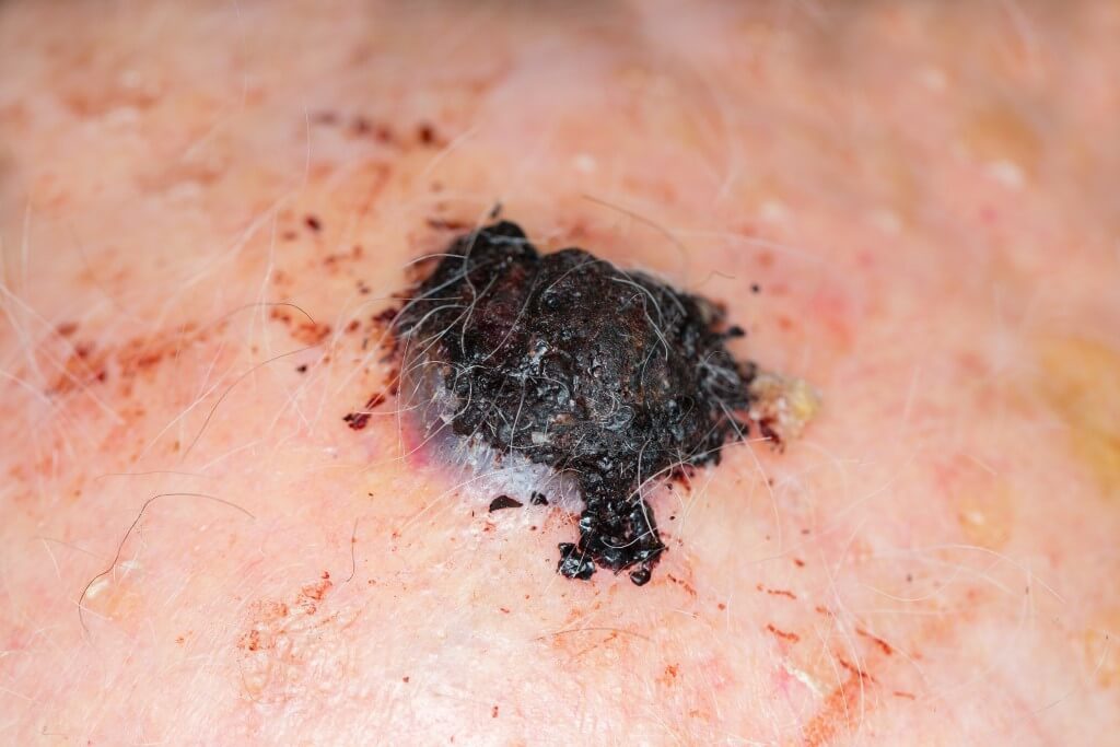 Comment Soigner les Carcinomes Sans la chirurgie