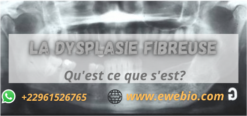 Traitement Possible pour La dysplasie fibreuse