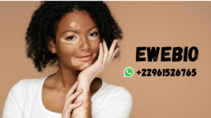 Les Informations sur le Vitiligo pour Soigner