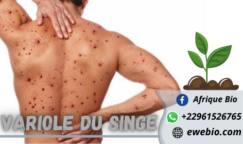 Soigner Variole du Singe en Afrique