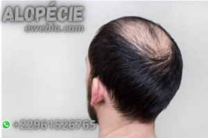 Recette pour Soigner L'Alopécie