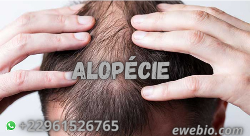 Recette pour Soigner L'Alopécie