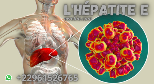 Prise en charge pour L'Hépatite E