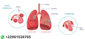 Plantes Pour La fibrose pulmonaire